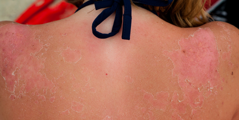 Sunburn and peeling skin on a woman's shoulders